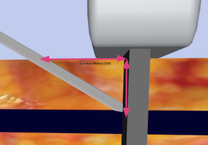 Image showing needle depth and length